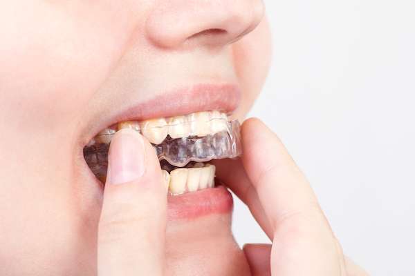 5 Things You May Not Have Known About Clear Braces from Lake Worth Dentistry in Greenacres, FL