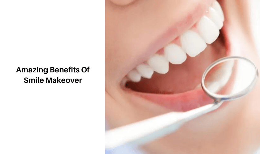 Amazing Benefits Of Smile Makeover