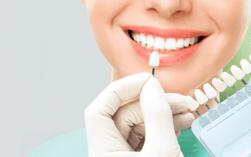 Dental Veneers - Lake Worth Dentistry
