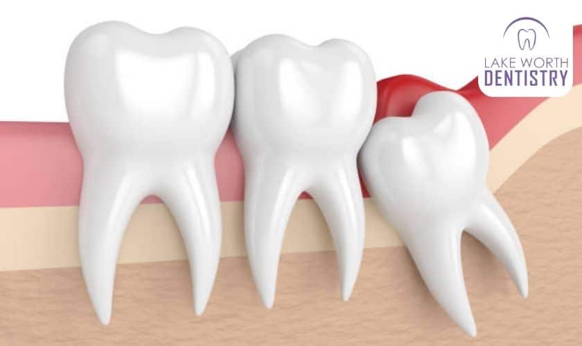 How To Prepare For Multiple Tooth Extraction?