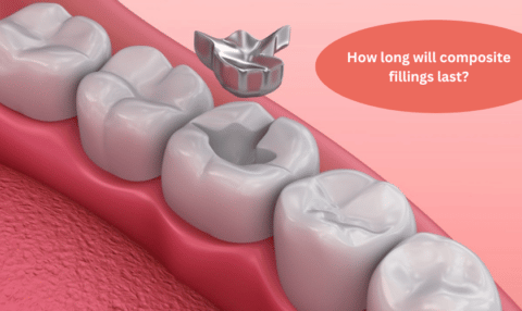 How long will composite fillings last?