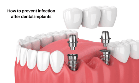 How to prevent infection after dental implants