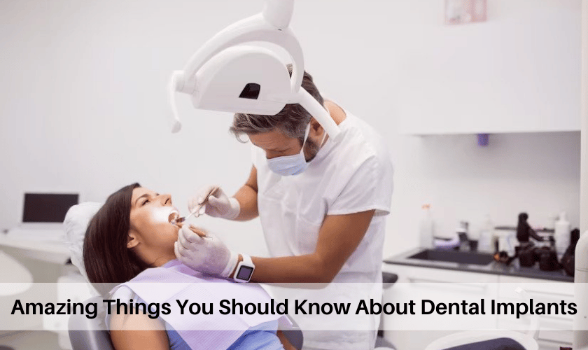Amazing Things You Should Know About Dental Implants