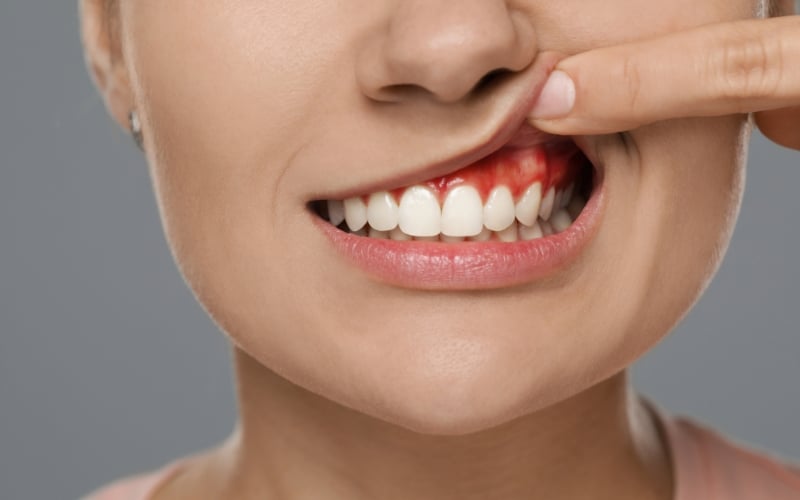 Can Brushing Too Hard Cause Gum Disease?