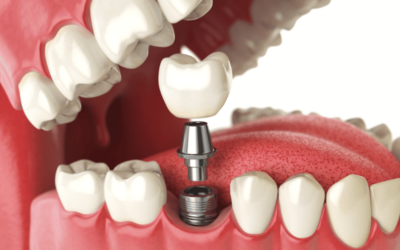 What Are The Benefits Of Dental Implants For Seniors?