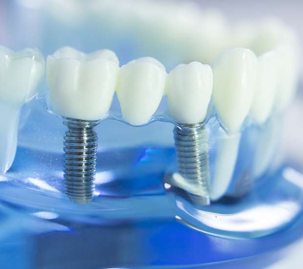 Greenacres Dental Implants