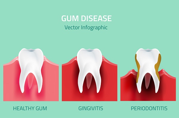 Gum Disease Greenacres, FL