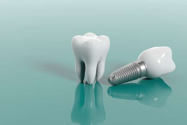 Multiple Teeth Replacement Options: One Implant for Two Teeth from Lake Worth Dentistry in Greenacres, FL