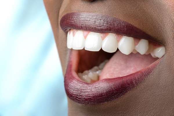 Routine Dental Care: What Are Tooth Colored Fillings from Lake Worth Dentistry in Greenacres, FL